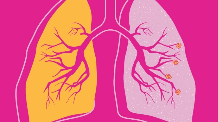 COPD Progression