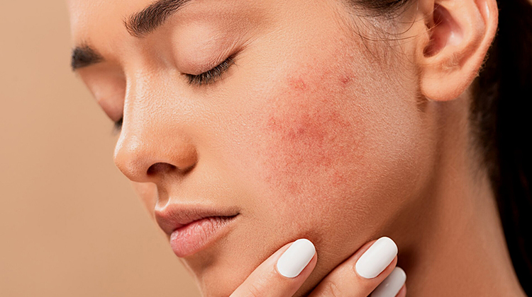 Cbd salve for acne